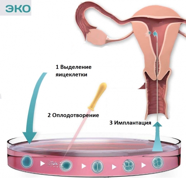 В чем разница бесплатного и платного ЭКО